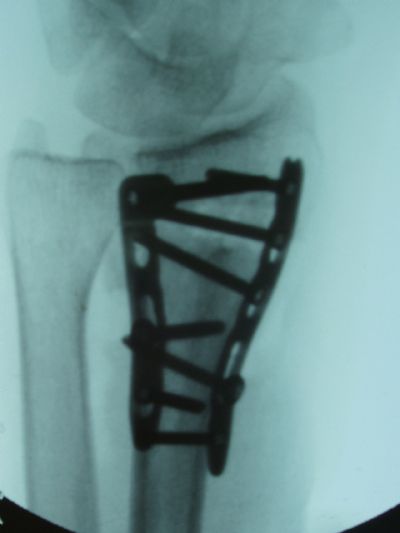 Radius, Distal:  Synthes Locking Plates (Implant 178)